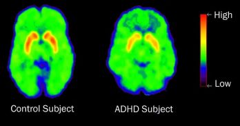 Imaging of the Normal Brain in Contrast to the ADHD brain